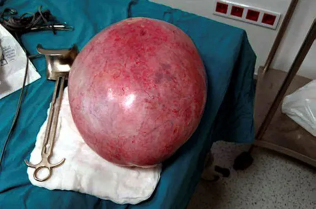 Ağrı şikayeti ile hastaneye gitti! 18 yaşındaki kızın karnından 9 kilo 800 gram kitle çıkarıldı