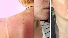 Dermatologlar bu 3 mucizevi yöntemi öneriyor: Eski yara izlerine eIveda
