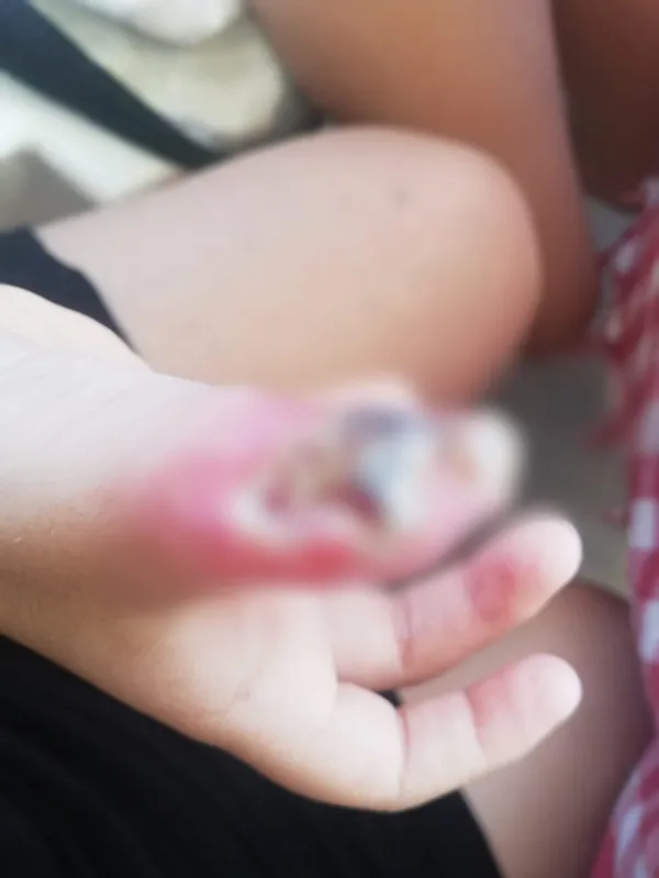 6-yasindaki-elif-kucuksorgulunun-girdigi-mr-sonrasi-eli-ve-kolunda-yaniklar-olustu-anneden-isyan-eden-sozler-1653904281499.jpg 6 yaşındaki Elif Küçüksorgulu'nun girdiği MR sonrası eli ve kolunda yanıklar oluştu! Anneden isyan eden sözler-6