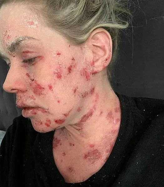 Güney Afrika’da yaşayan Samantha Saunders'ın hayatı bir krem ile değişti! Sebebini öğrenenler şoke oldu-1