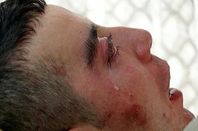 Subakut Sklerozan Panensefalit hastası Halil Özçelik 5 yıldır gözlerini kırpamıyor