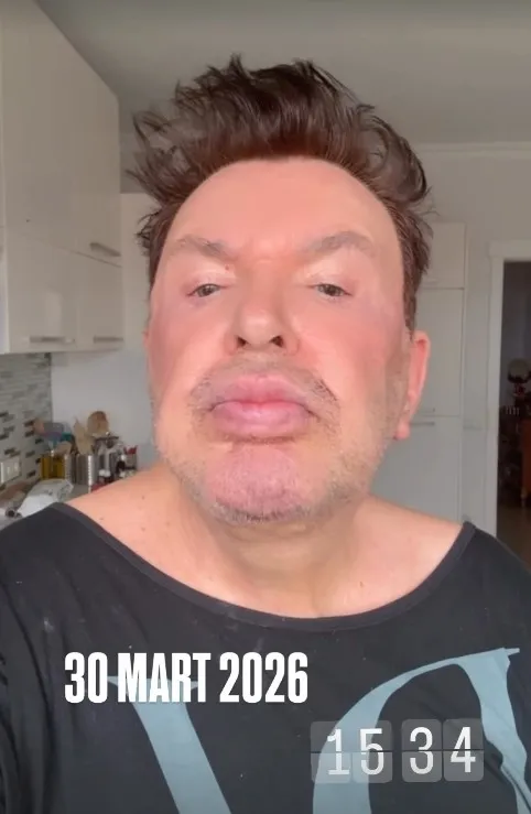 kusum-aydin-son-halini-paylasti-iste-estetik-sonrasi-yeni-hali-1774938864043.jpg Kuşum Aydın son halini paylaştı! İşte estetik sonrası yeni hali-3