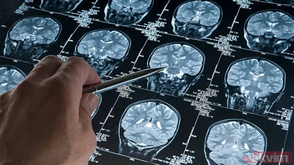 Alzheimer için yeni umut: Bilim insanları zehirli proteini temizleyen hücreler keşfetti - 4
