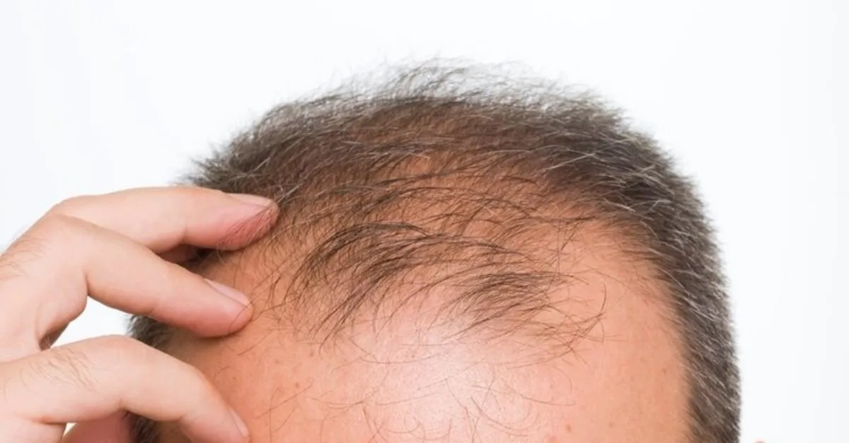 sac dokulmesi ve kelligin merhemi bulundu bilim insanlarindan sasirtan kesif galeri takvim