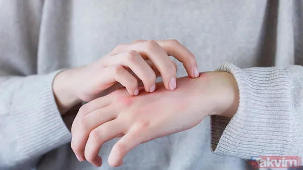 Egzama, sedef, kaşıntı… Canan Karatay cilt hastalıklarının gerçek nedenini açıkladı - 7