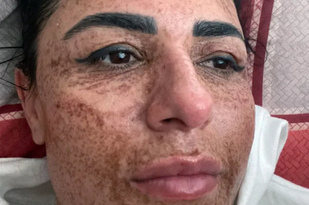 8 ay önce güzellik merkezinde yüzü yanan kadın tedavi sonrası artık aynaya bakabiliyor