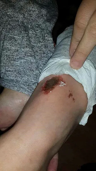 Afyonkarahisar'da kar topu oynayan çocukların üzerindeki yanıkların nedeni belli oldu!-3