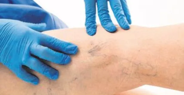 Hareketsizlik beraberinde fazla kilo ve varis getiriyor!