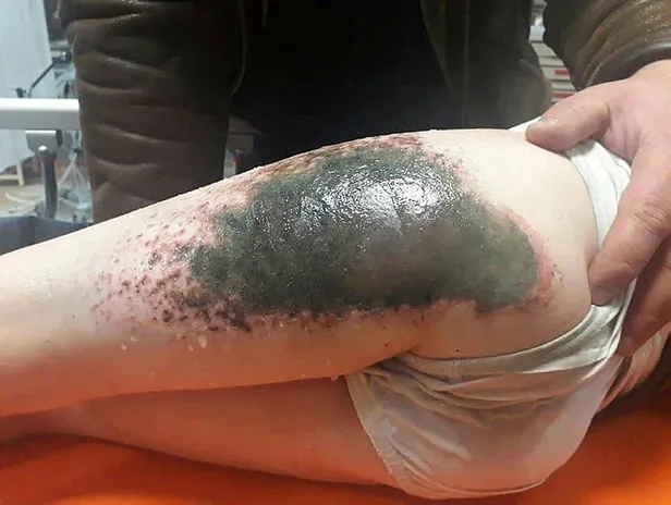 Afyonkarahisar'da kar topu oynayan çocukların üzerindeki yanıkların nedeni belli oldu!-1