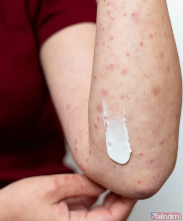 👚 Kıyafet Tercihi Önemli: Dar Ve Sentetik Kumaşlardan Uzak Durun Yazın Serin Kalmak Kadar, Cildi Rahat Bırakmak Da Önemli. Sıkı Ve Sentetik Kumaşlardan Yapılan...